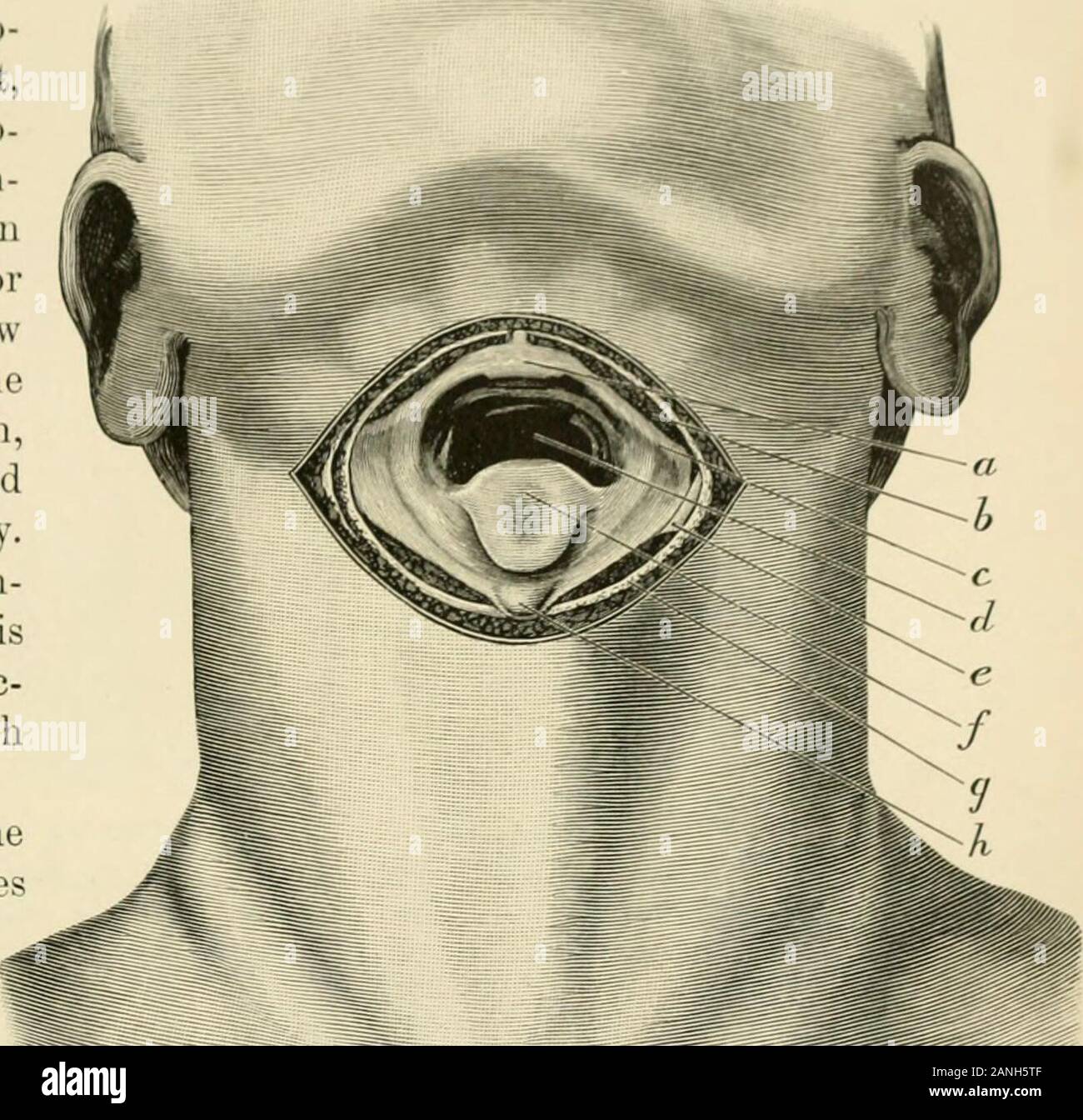 Trautsmann Triangle Operative surgery . atient. A preliminary tra-cheotomy should ...