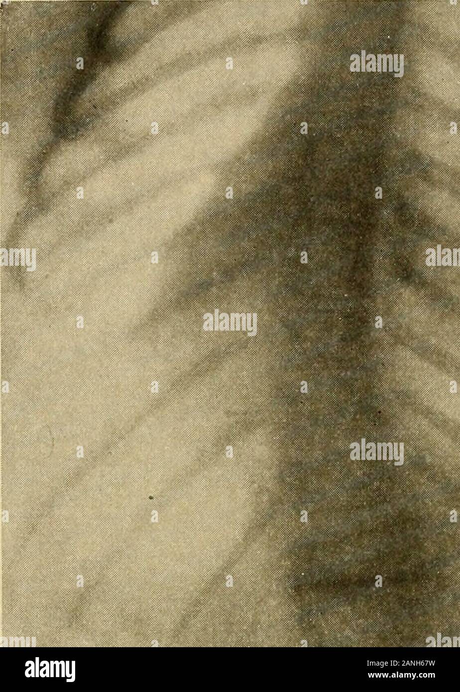 Lateral curvature of the spine and round shoulders . he changed
