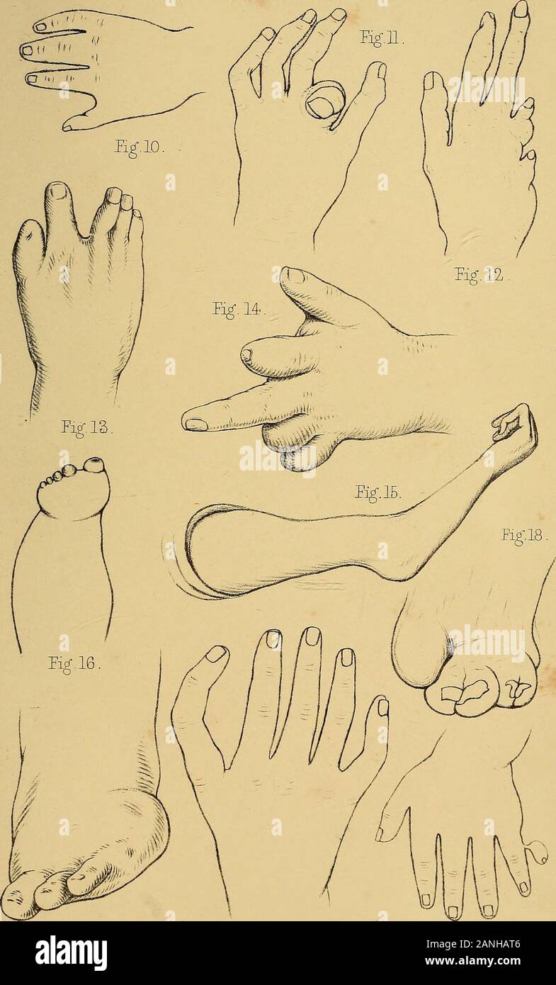 The malformations, diseases and injuries of the fingers and toes and ...