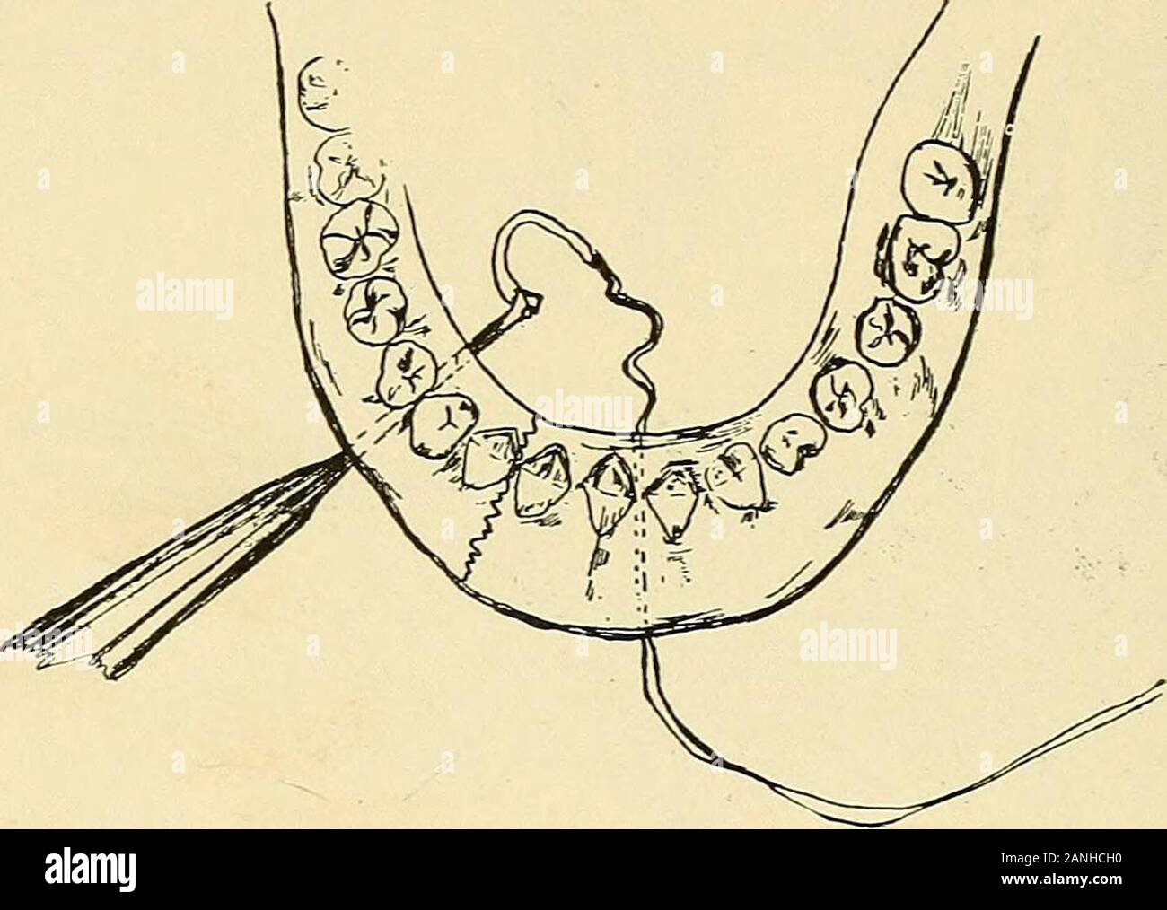 Oral surgery; a text-book on general surgery and medicine as applied to dentistry . Fig. 202.—Notched Drill and Wire. Showing method of attaching thread. of about half an inch. The object in wiring was to pull theanterior fragment upward against the posterior. Sincethe molar was perfectly solid, it served for an anchorage.The drill was passed through between the roots of the bi-cuspids. This furnished an upward and backward tractionand a perfect adjustment w^as not difficult. Union followed,and the wire was removed in six weeks, with perfect articu-lation and no external deformity. 400 FRACTUR Stock Photo