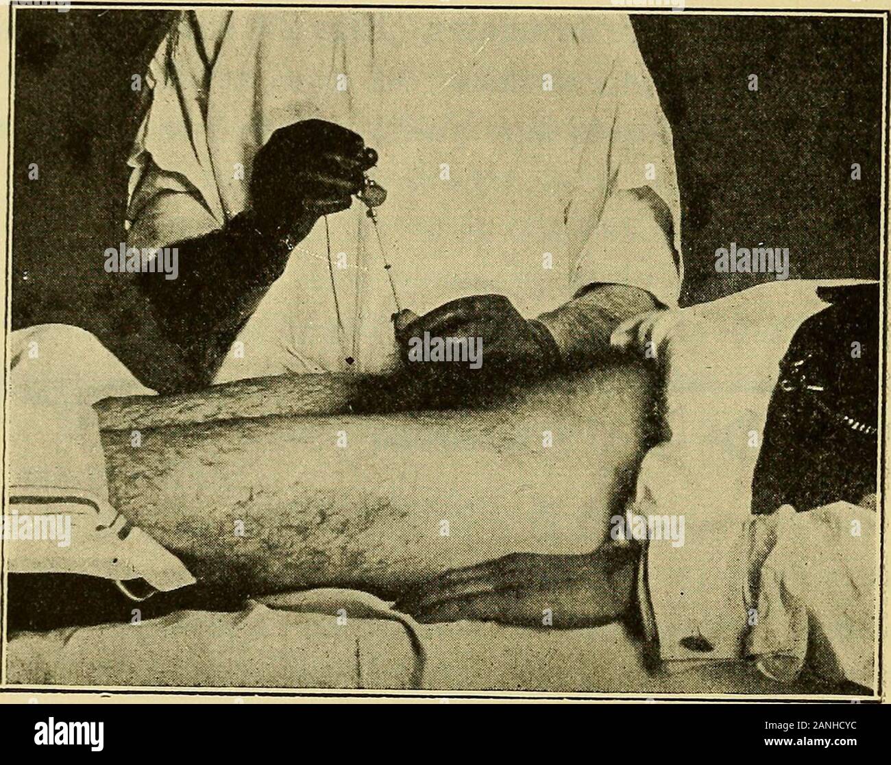 Gonorrhea in the male : a practical guide to its treatment . FlG. 27. Otis Urethrometer. serted into the urethra the latter should be testedby quickly expanding the extremity to its maximumextent (45 French). This insures the trustworthi-ness of the rubber cover. The instrument is steril-ized, cover and all, and introduced gently down tothe deep urethra, the bulb being at its minimum(15 French). This dilatable bulb is now expandedby turning the revolving cap up to 30 French, asper index, and the instrument gently drawn forwardtoward the meatus (Fig. 28). Any infringementon the urethral caliber Stock Photo