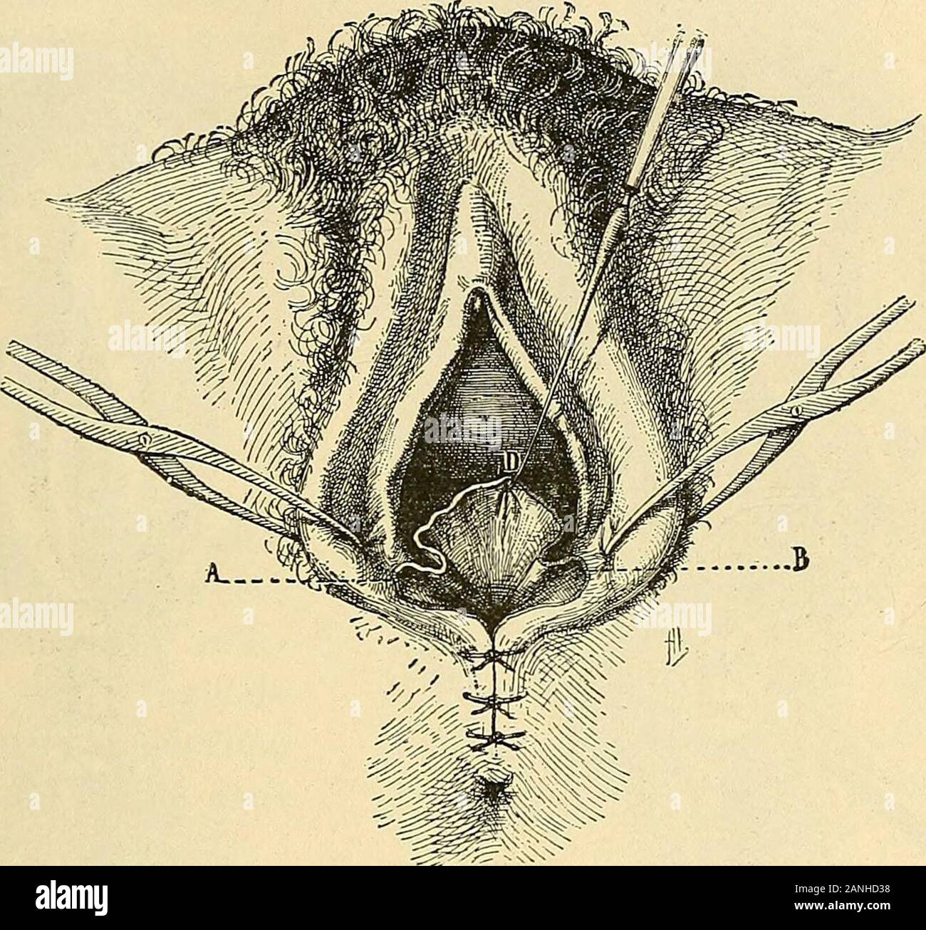 Traité de gynécologie clinique et opératoire . disséquée, puis est enlevée  avec despinces. Lopérateur ne se sert plus alors que de lindex de la  maingauche, qui sengage lentement en fouillant les tissus