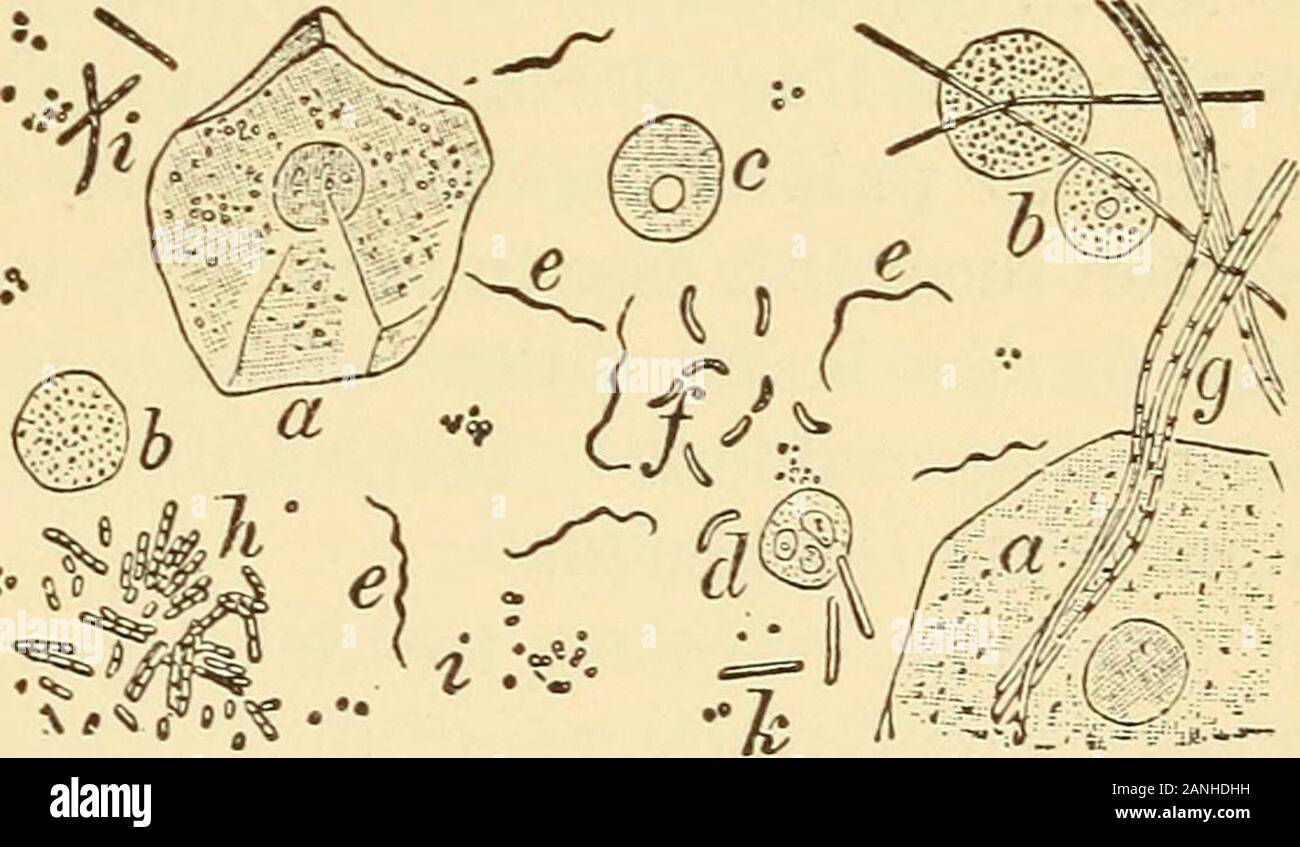 A Text Book On Diseases Of The Ear Nose And Throat Ike The Tendrils Of A Running Vine If A Bit Of Deposit Be Torn Ofi Teased In Glycerin And Examined Witha