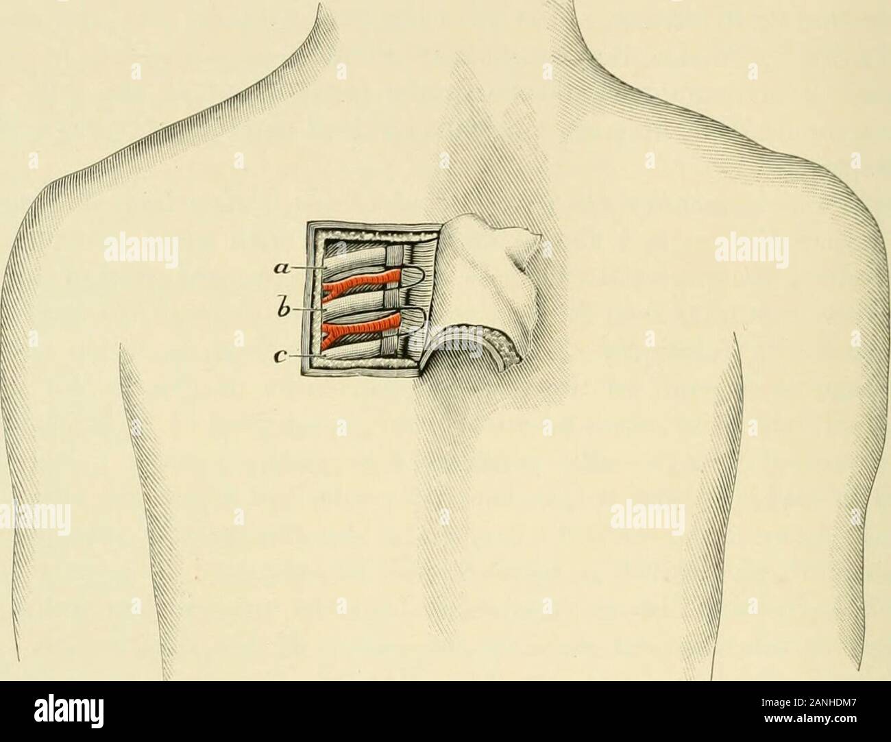 Operative surgery . ldbe displaced from the angles to the outer