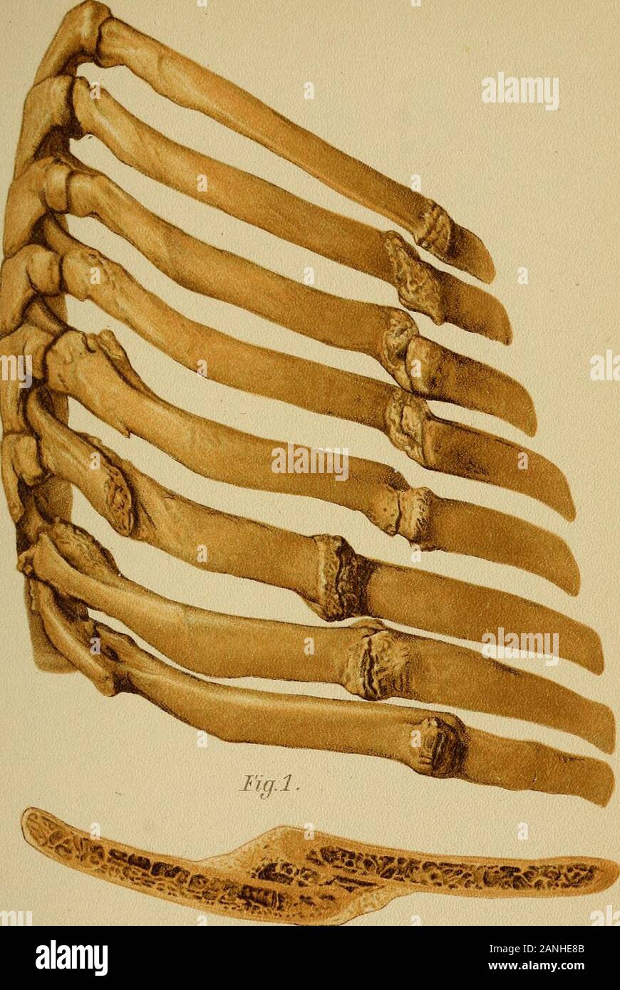Atlas and epitome of traumatic fractures and dislocations . no