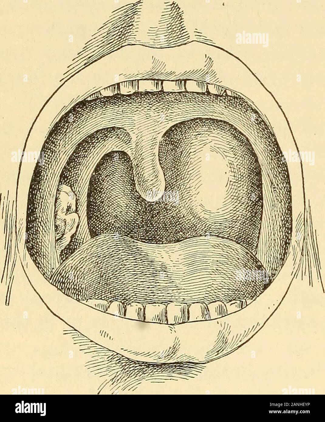 A text-book on diseases of the ear, nose and throat . the appear-ance of  this feature. There issometimes a forward bulging of thesoft palate. The  iDrincipal danger previousto rupture is oedema of