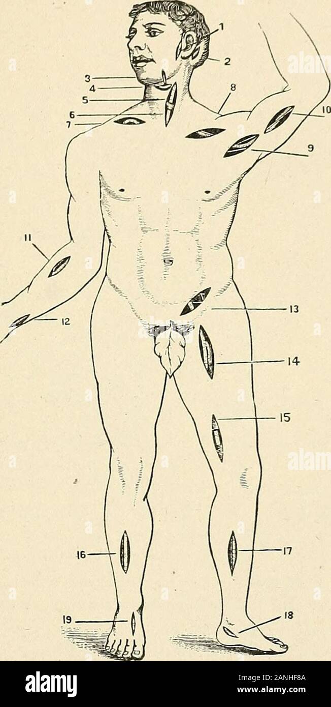A text-book of first aid and emergency treatment . Fig. 30.—Tourniquet ...