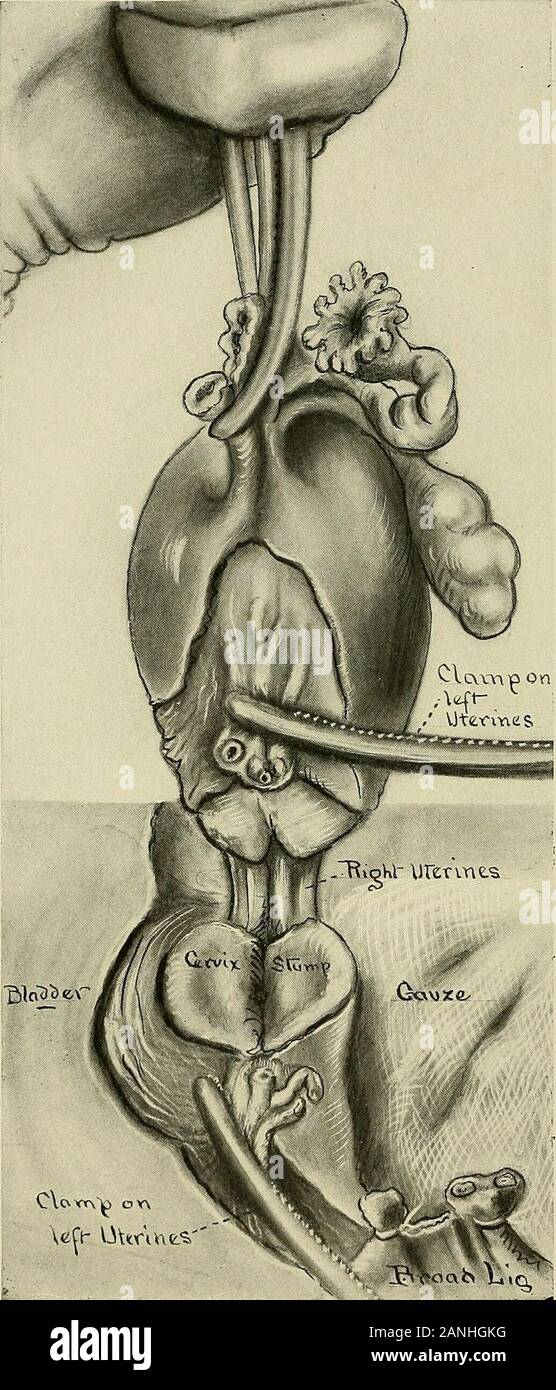 Gynecology . Fig. 322.—Supravaginal Hysterectomy. Second Step of