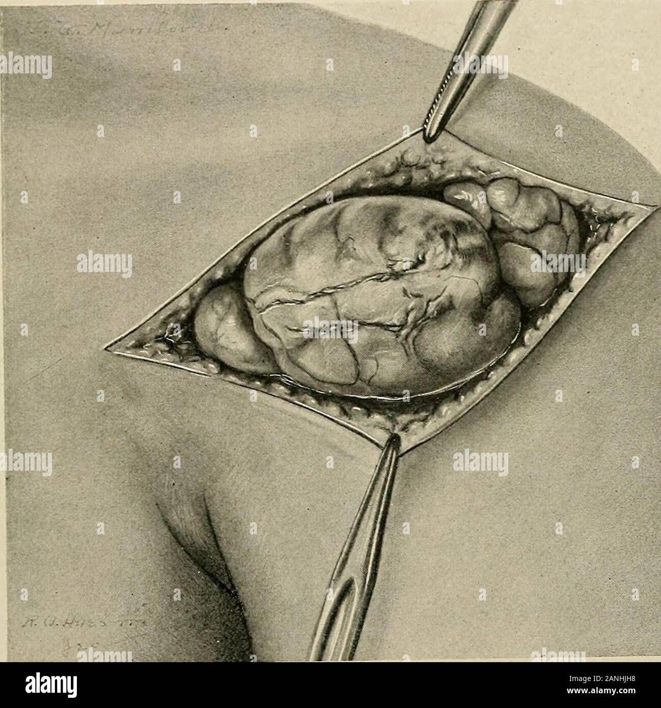 The practice of surgery . e asa dinner-plate, when situated between the shoulders, is not troublesome.A fatty tumor the size of a mans thumb, if it protrude into the knee-joint, may cause great pain and result in serious crippling. Thelipoma arborescens of Midler is xhe common example of the latter TUMORS OF THE CONNECTIVE-TISSUE TYPE 827 form, the joint lipoma, and is often associated with rheumatoid arthritis.Subserous lipomata situated behind the peritoneum may attain enormoussize; may occur at almost any age; may seriously interfere with visceralfunction; and may be mistaken for grave abdo Stock Photo