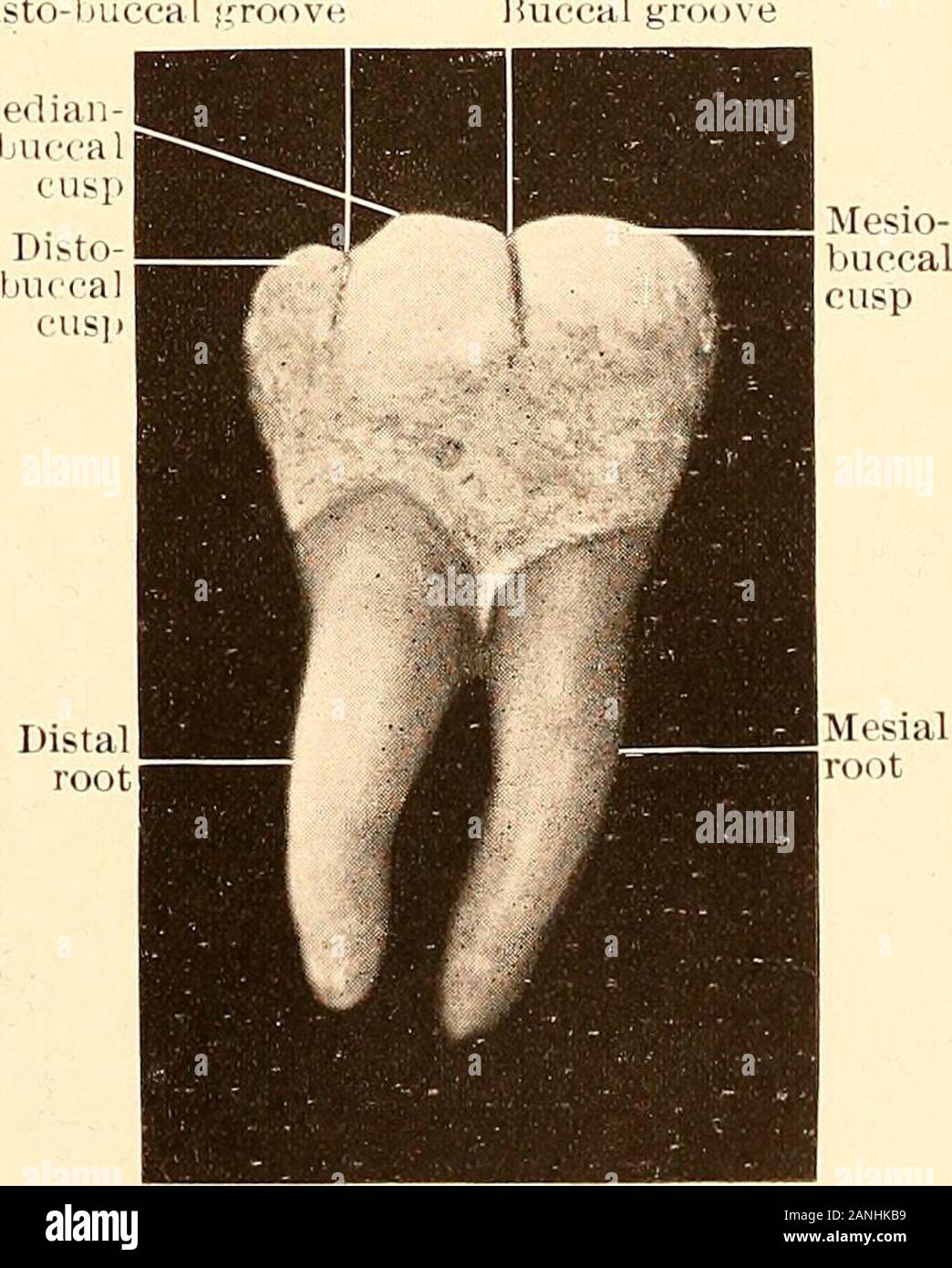 Principles and practice of operative dentistry . Mesiolingual cuspFig