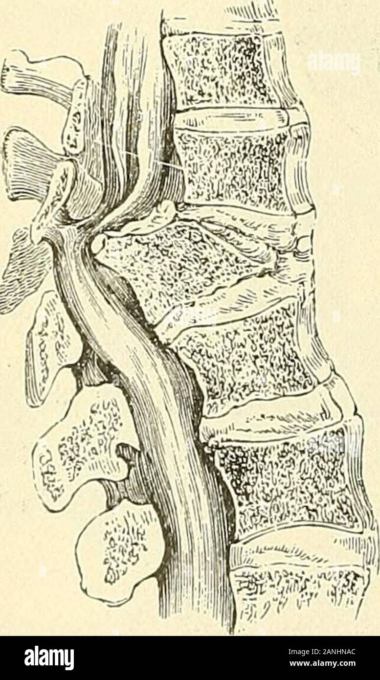 A practical treatise on fractures and dislocations . g lost its