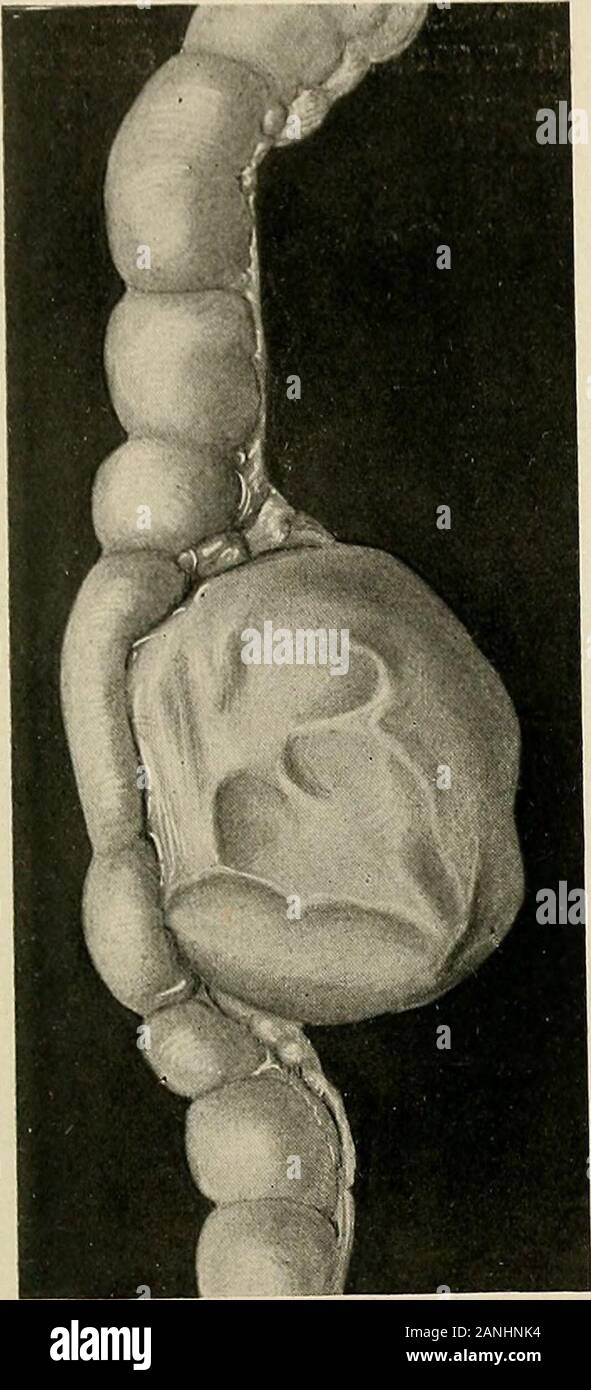 The Practice Of Surgery Eady Described In Chapterxi The More Familiar Forms Of Cysts Connected With The Female Genera Tive Organs And In Chapter Xv The Analogous Cysts Of The Male Organs