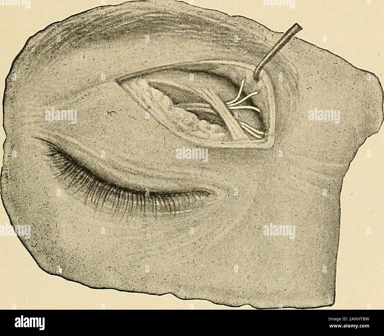 Oral surgery; a text-book on general surgery and medicine as applied to dentistry . ion is made over theinfraorbital foramen, the stem of the incision extendingdownward through the cheek. After the nerve is exposed,it may be torn from its peripheral attachment. It is nownecessary to open the canal by chiseling away the bone,making the opening sufficiently large to permit the nerveto be forced back along the floor of the orbit to near itsapex. This is done with a narrow periosteal elevator. Thenerve thus freed is grasped as deeply down as possible bya narrow but strong forceps, and by tugging a Stock Photo