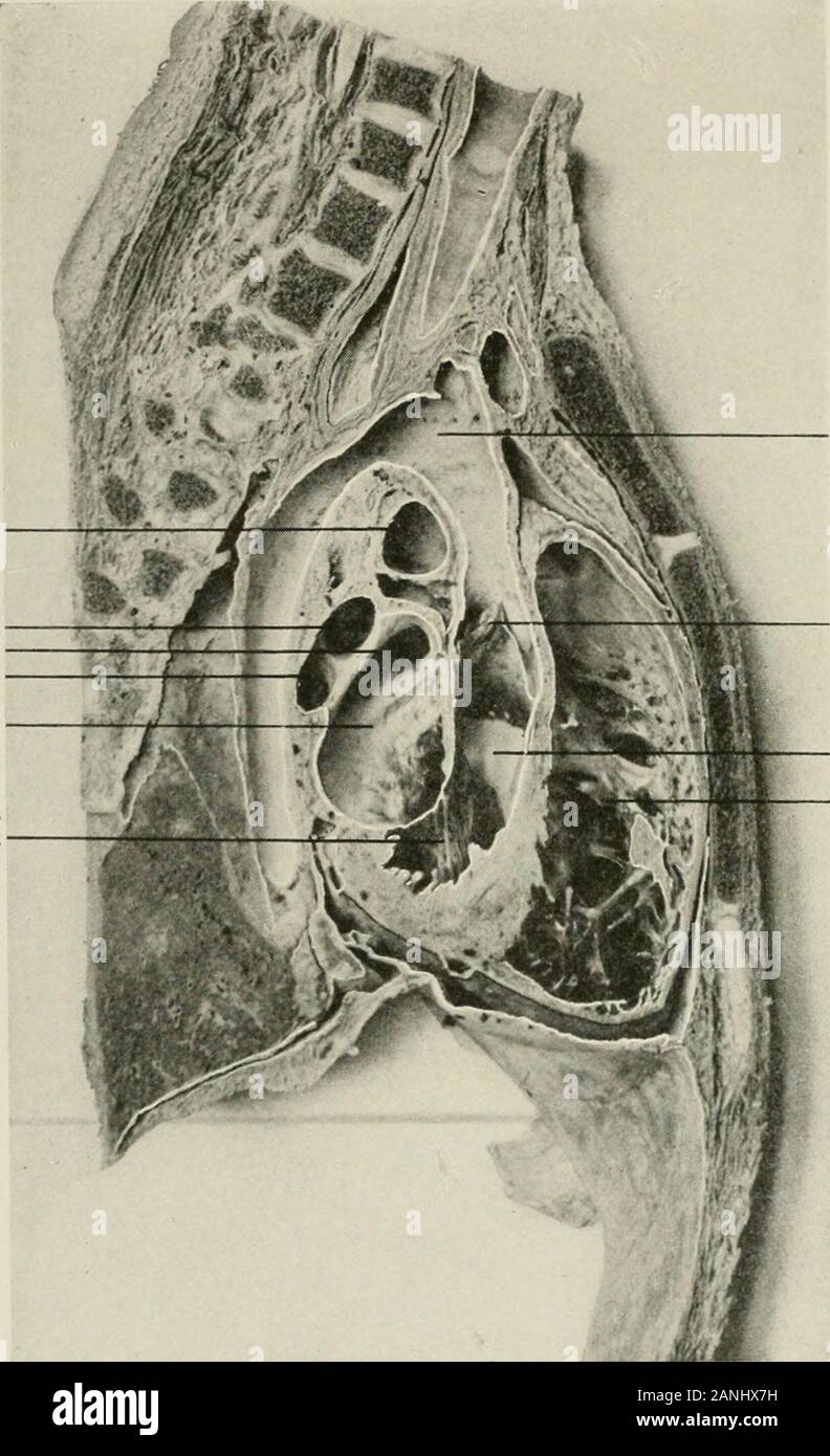 Diseases of the chest and the principles of physical diagnosis . Right