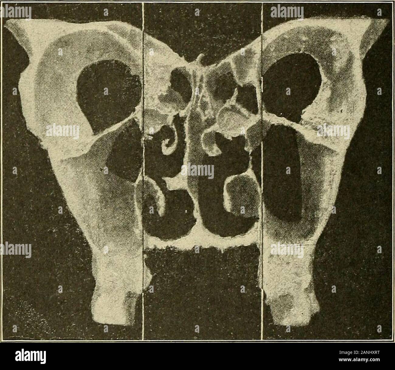 Oral surgery; a text-book on general surgery and medicine as applied to dentistry . the middle turbinate bone. U, uncinate process, which is placedobliquely and forms the internal wall of the infundibulum; s, septum nasi;m.t., middle turbinate. On the left side this turbinate contains a cell (c)which communicates with the middle meatus, as shown by an arrow. i.L,inferior turbinate; o.p., os planum. (Lathrop.) the external wall of the nasal cavity, is immediately aboveand on a perpendicular line with the internal surface of thealveolar process from the second bicuspid backward to thelast molar. Stock Photo