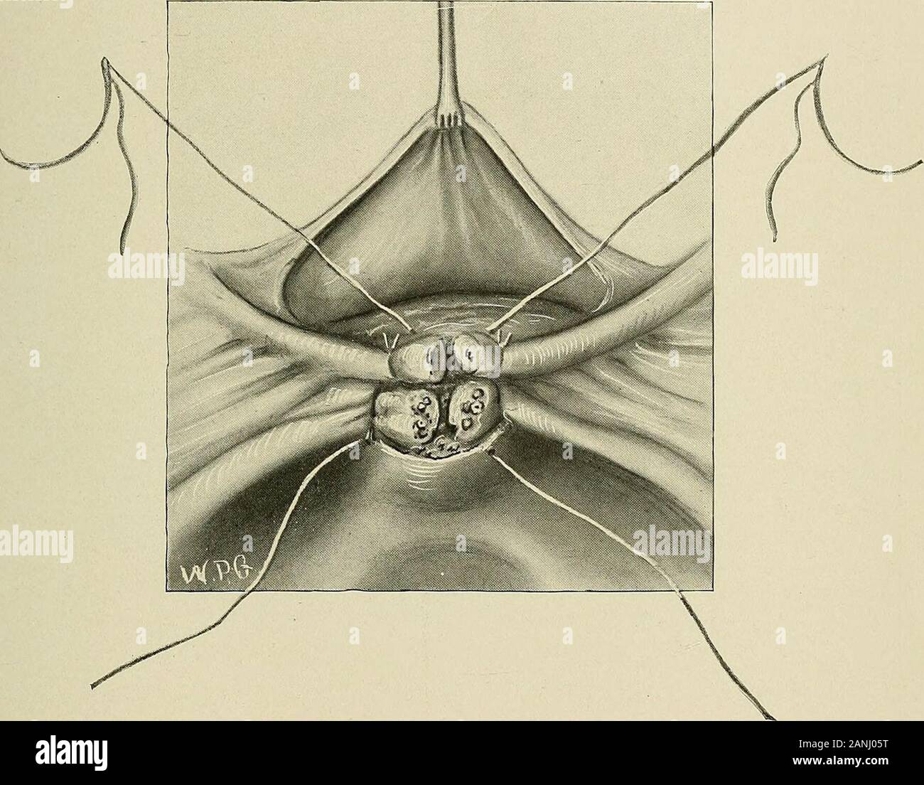 Trendelenburg modifié