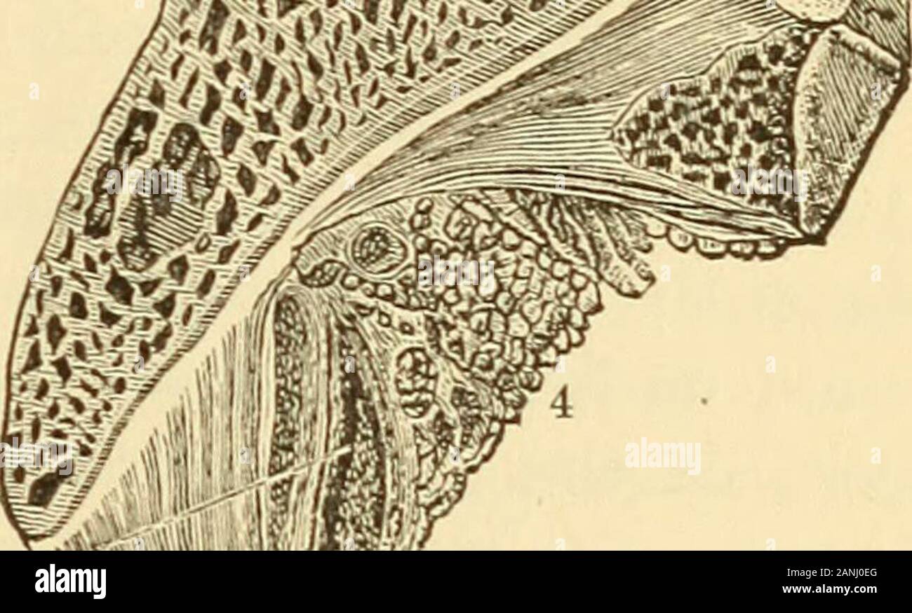 A text-book on diseases of the ear, nose and throat . Adenoid tissue at vault of pharynx. Poste-rior wall of upper part of pharynx. (Luschka.)1, 1, pterygoid process; 2, section of vomer;3, 3, posterior portion of the vault of the nasalfossae; 4, 4, pharyngeal orifice of the Eu-stachian tube; 5, orifice of the bursa pha-ryngea ; 6, 6, recessus pharyngeus (fossa ofRosenmiiller) ; 7, median folds formed by theadenoid substance of the nasal portion of thepharynx. mm. Vww^^ Pharyngeal bursa. Antcio-postenorsection. (Luschka ) 1, section of basi-lar process of the occipital bone ; 2, bodyof sphenoi Stock Photo
