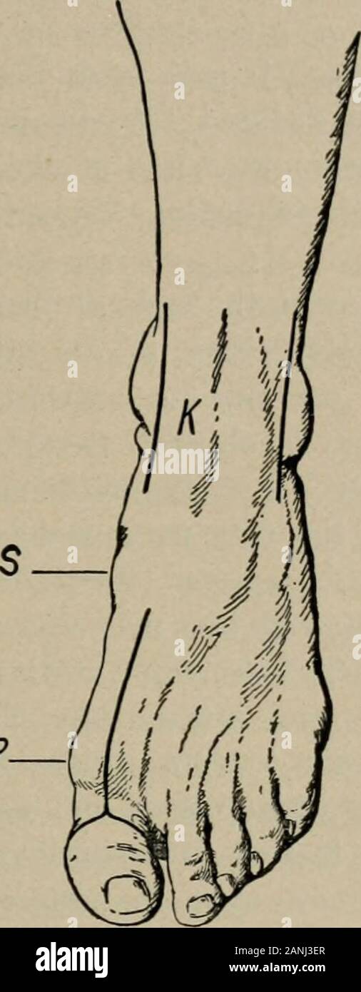 Operative surgery, for students and practitioners . of the astragalus thus brought into view.The joint between the head of the astragalus and the scaphoid isopened (tuberosity of the scaphoid is the guide), and also the jointbetween the astragalus and the os calcis (sustentaculum tali) ; afterthis the astragalus is seized with a bone-forceps, and, twisting andat the same time cutting close to the bone, it is removed. In re-secting the ankle-joint for tuberculosis, if the astragalus is diseased,it is well to remove this bone entire. AMPUTATIONS, RESECTIONS, ETC. 80 AxKLE-JOiXT (Koexig).—Tliis i Stock Photo