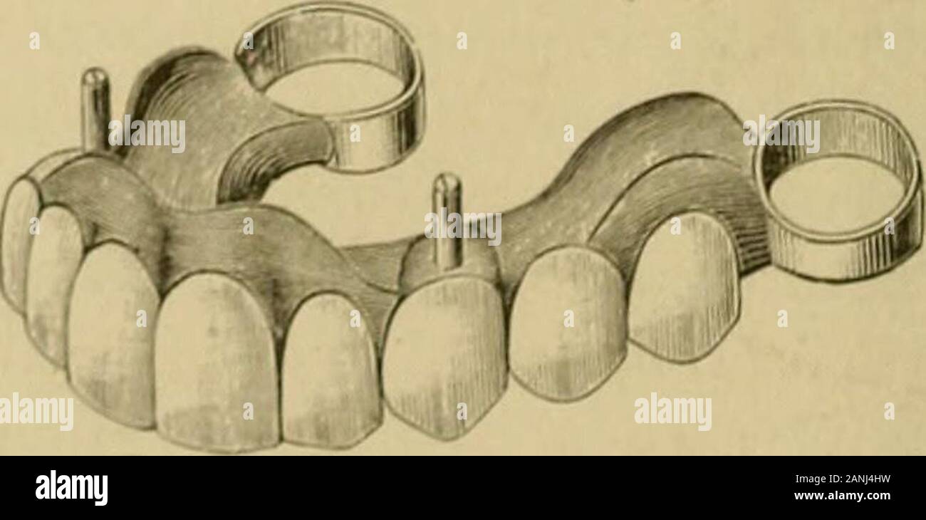 A practical treatise on artificial crown- and bridge-work . Fig. 419.. buccal Bides. The plate Intended to conned the abutments wasthen adjusted in position as 1ms been described. An impression was iit taken and a model and articulation made. The cuspids REMOVABLE PLATE BRIDGES. 213 were then double-capped and collars formed od the molar crowns.The douMe caps, pivots, collars, and plate were next solderedtogether. The artificial teeth were attached with vulcanite, thegum section being formed with pink. In order to avoid anywarping, which might readily occur in the construction of solarge a de Stock Photo
