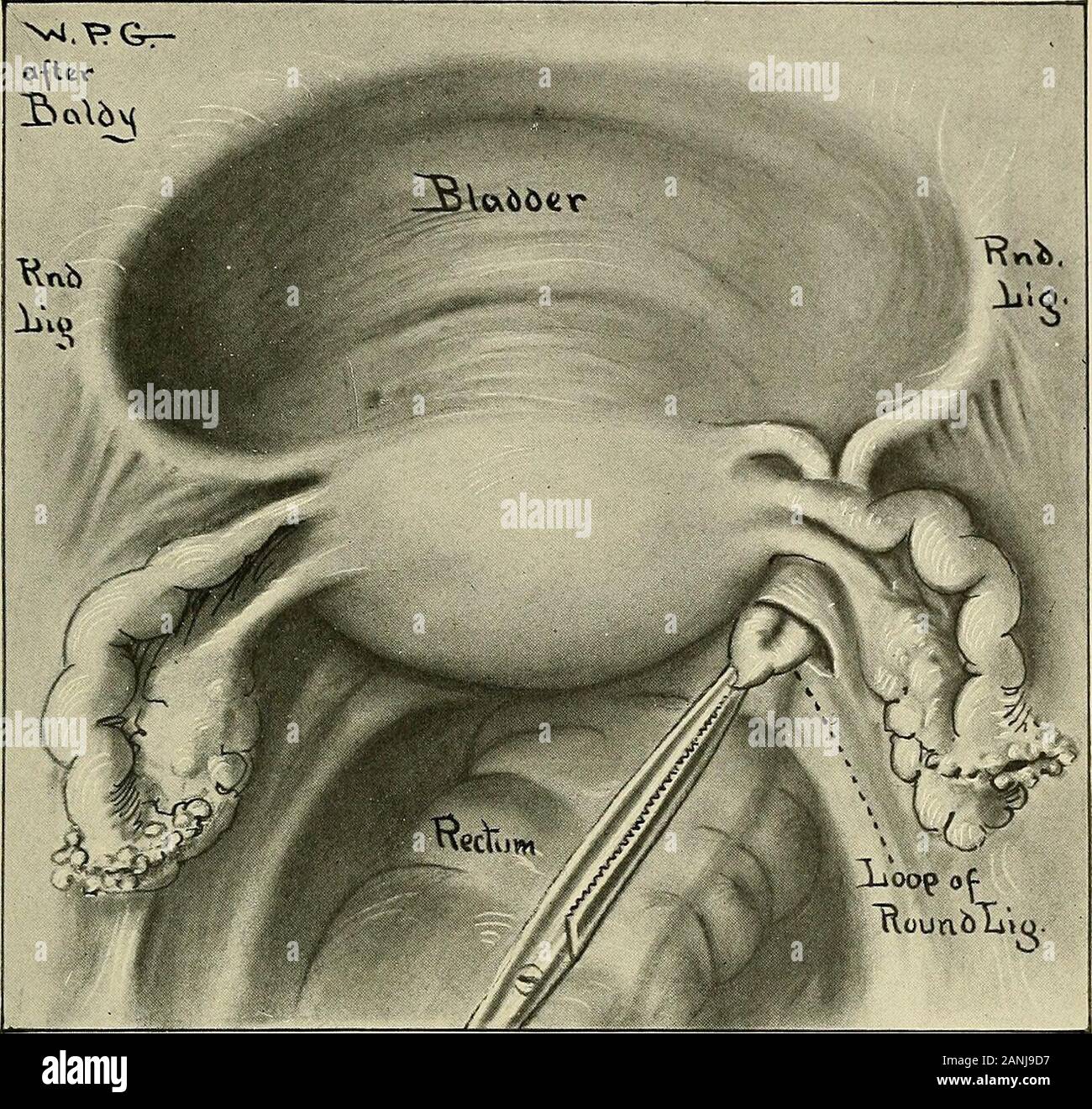 Gynecology . Fig. 287.—Baldy-Webster Operation for Retroversion. An opening is made through the broad ligament just under the suspensory ligament of the ovary. A half-length forceps passed through the opening grasps the round ligament and draws it backward. just the right level on the back of the uterus, for if the attachment is too lowthe uterus may become retroflexed over the ligaments, and if the attachmentis made too high there is danger of causing an anteflexion of the uterus. Theperforation of the broad ligaments and the suture of the round ligaments mustbe done with as little damage to Stock Photo