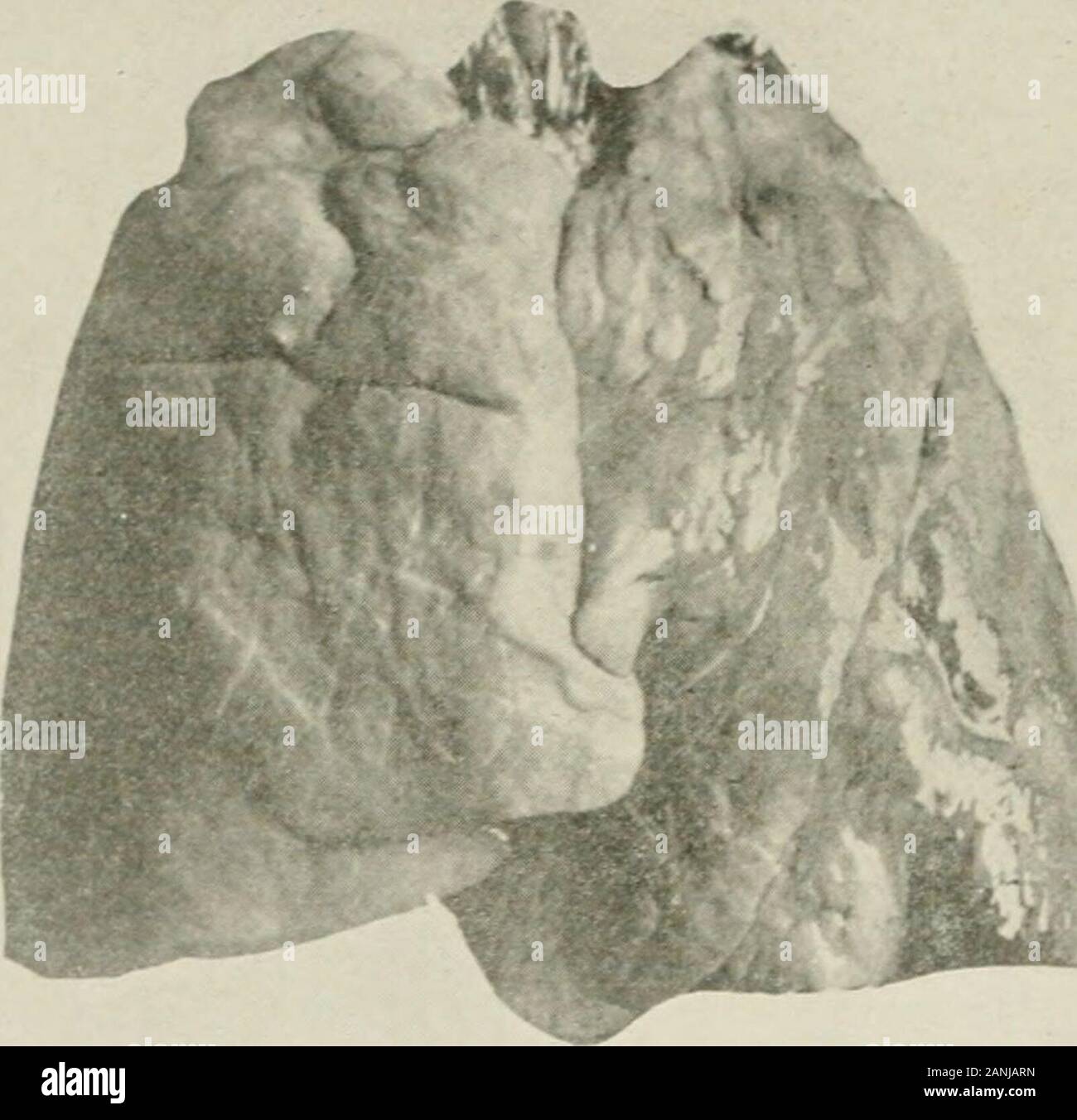 Diseases of the chest and the principles of physical diagnosis . .yield a cracked-potsound (p. 69). Percussion is generally less satisfactory than auscultation.The sense of resistance is often a valuable criterion in deciding betweenconsolidation and liquid effusion. The heart is large, lies higher in the thorax, as well as more horizon-tally. Cardiac dulness, therefore, normally extends relatively further tothe left than in adults. It may normally extend &gt;^ inch beyond the mid-clavicular line. Dulness due to the right auricle, however, rarely extendsbeyond the sternal line. The great vesse Stock Photo