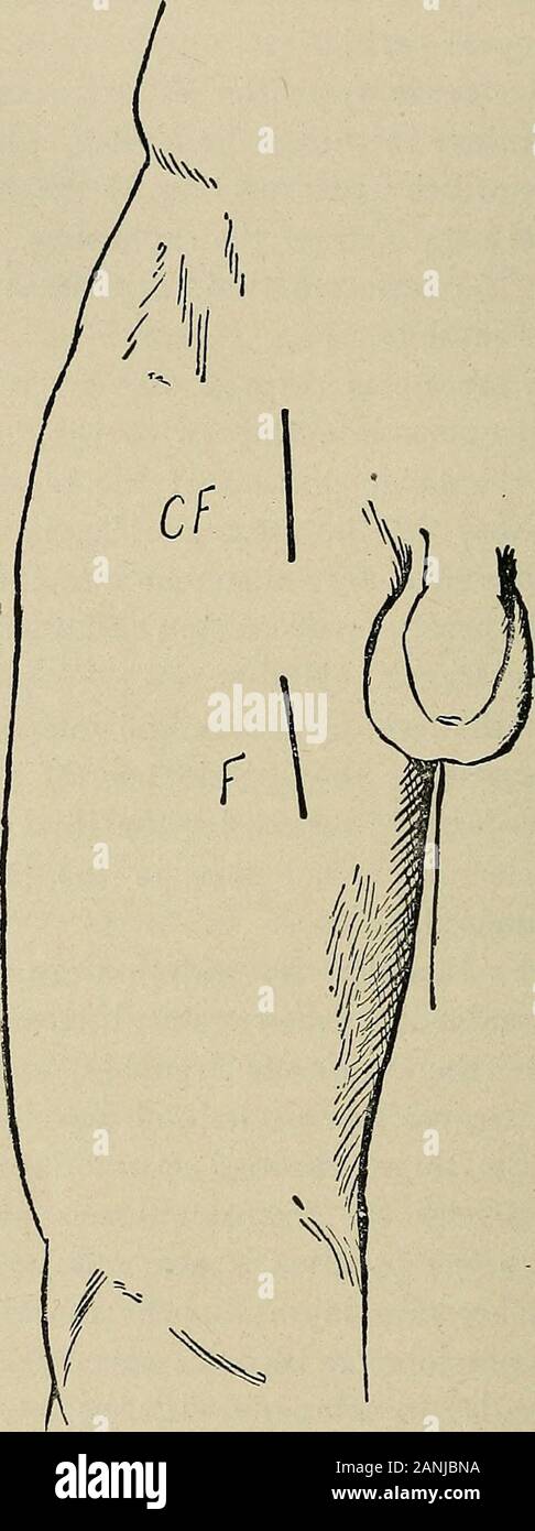 Operative surgery, for students and practitioners . n Scarpas triangle, and accompanies it down alongthe inner side of the thigh, through Hunters canal. At the lowerend of the canal, where the femoral vessels pass through the ad-ductor foramen into the popliteal spac« and just above the internalcondyle, the nerve becomes more superficial, lying beneath the sar-torius; below the knee-joint it l)ecomes subcutaneous, and runs downthe inner side of the leg in company with the internal saphenous vein,and supplies the skin of the leg. Ligation of the Femoral Artery. The Common Femoral.—The common fe Stock Photo