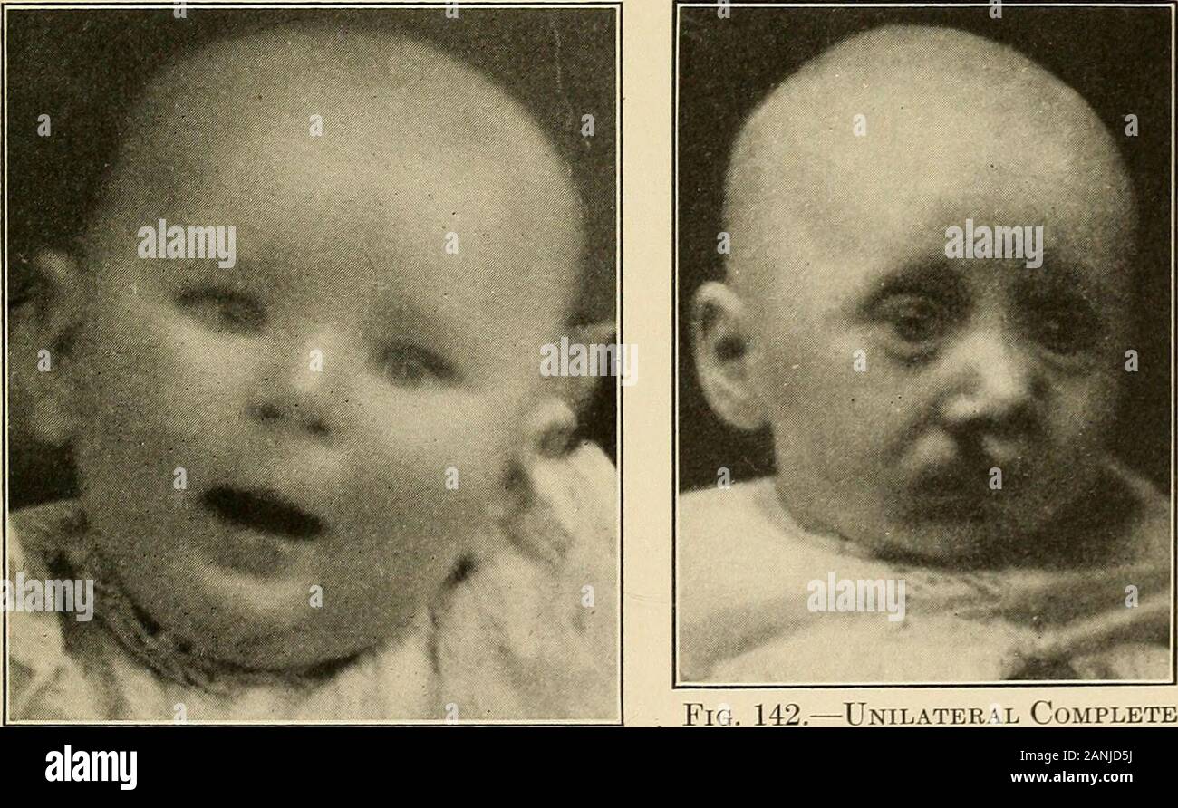 Oral surgery; a text-book on general surgery and medicine as applied to dentistry . FiG. 140.—Bilateral Incomplete Hare Lip.. Fig. 141.—Result of Operation. Fig. 142.—Unilateral CompleteHare Lip. 314 HARE LIP sists in making an arc incision tlirough the lip, parallel withthe margin of the cleft. By buckling the flap downward a transverse incision becomes a ver-tical one. Fillebrown makes astraight instead of a circular cut,otherwise his is the same as theoperation devised by Nelaton. Op-eration for double hare lip is prac-tically a double Miraults incision,the flaps removed being those fromthe Stock Photo