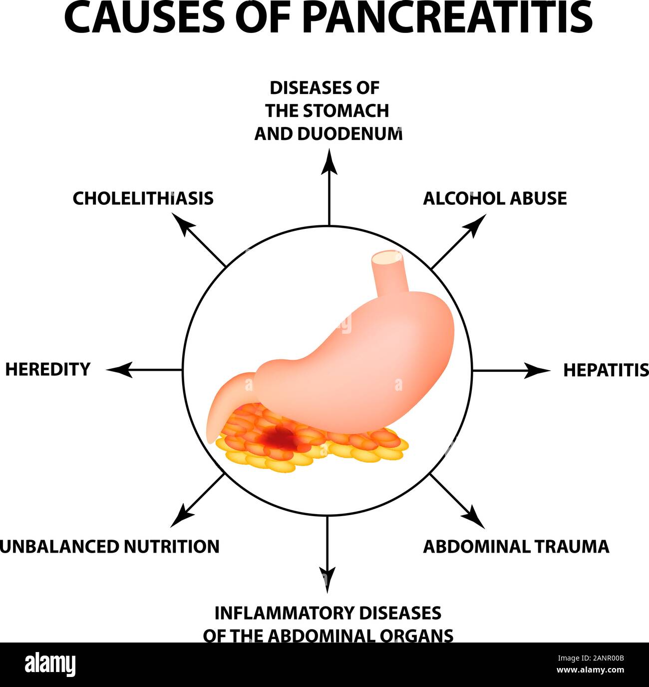 Causes of pancreatitis. The structure of the stomach and pancreas