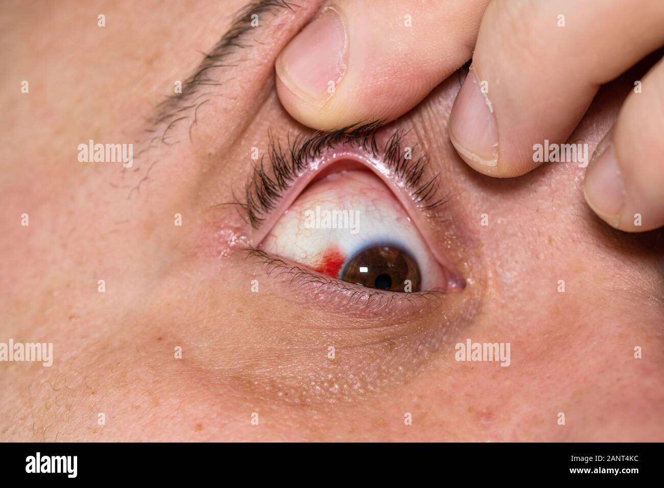 Eye injury, young man with burst blood vessel in eye, fatigue, problems with blood vessels Stock