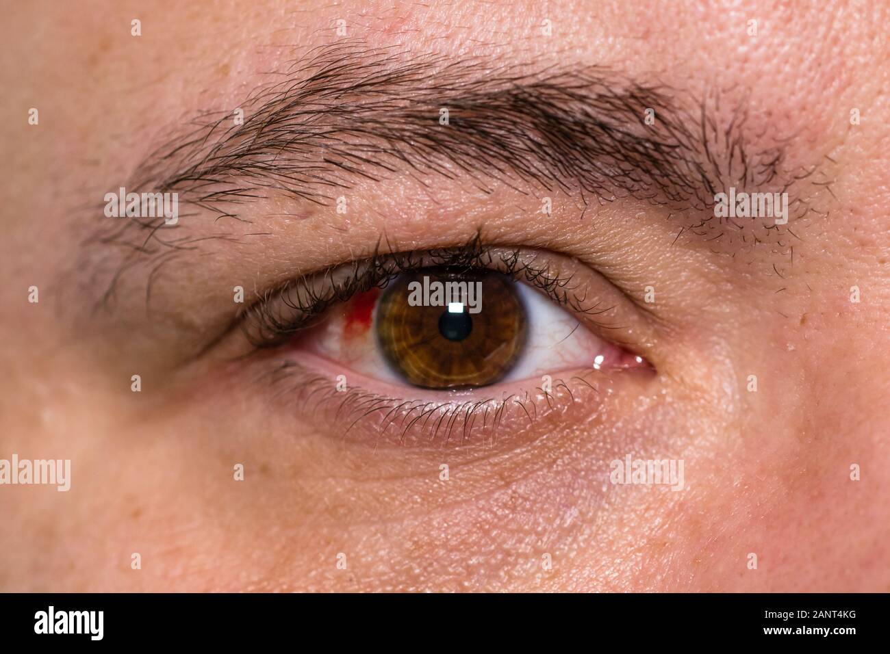 Eye injury, young man with burst blood vessel in eye, fatigue, problems with blood vessels Stock