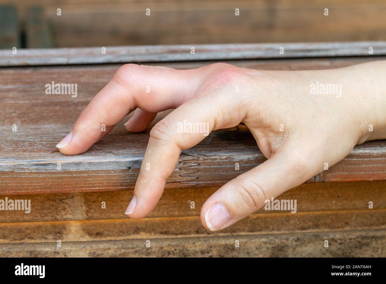 Skin allergy hires stock photography and images Alamy