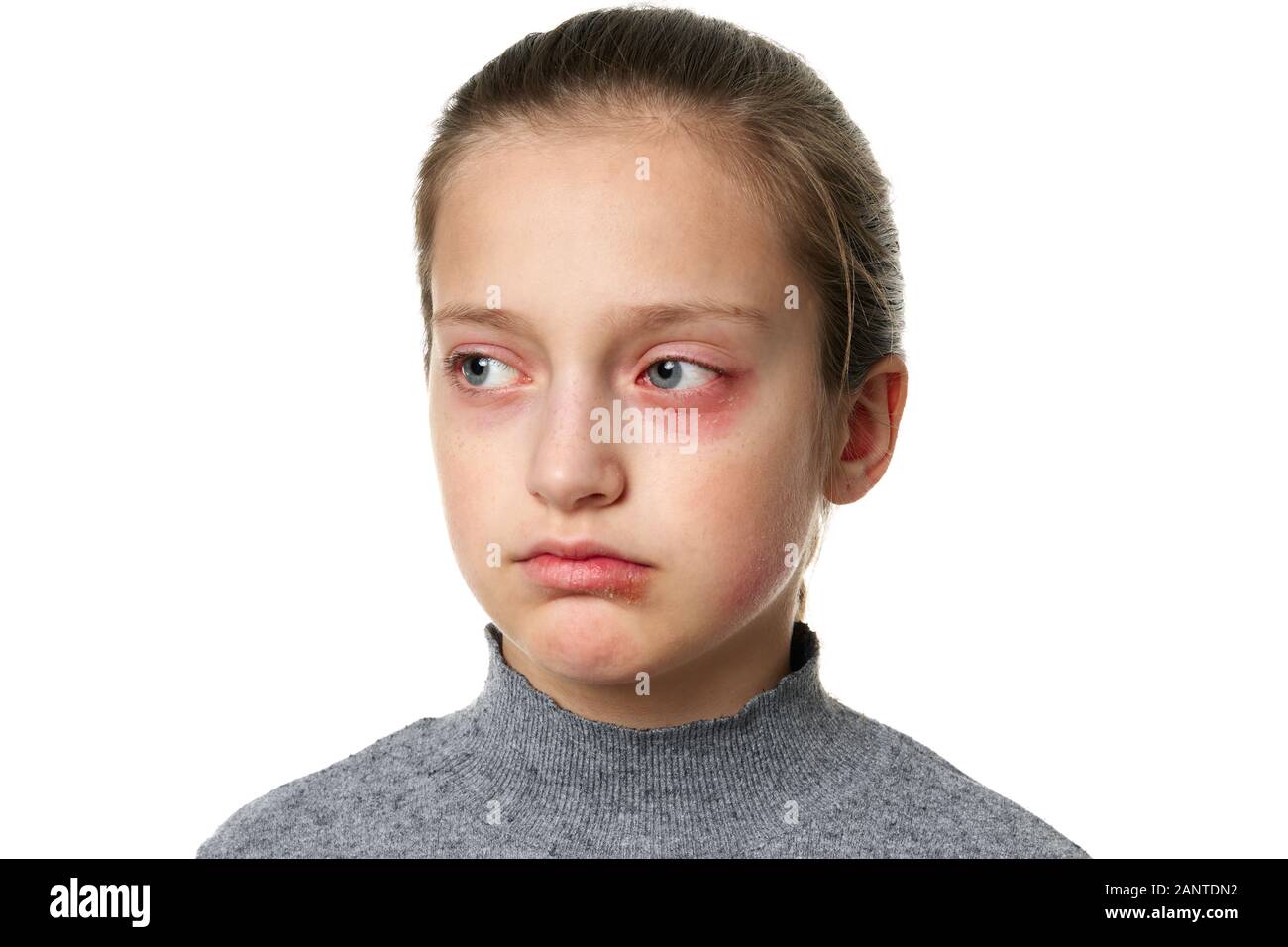 Allergic reaction, skin rash, close view portrait of a girl's face. Redness and inflammation of