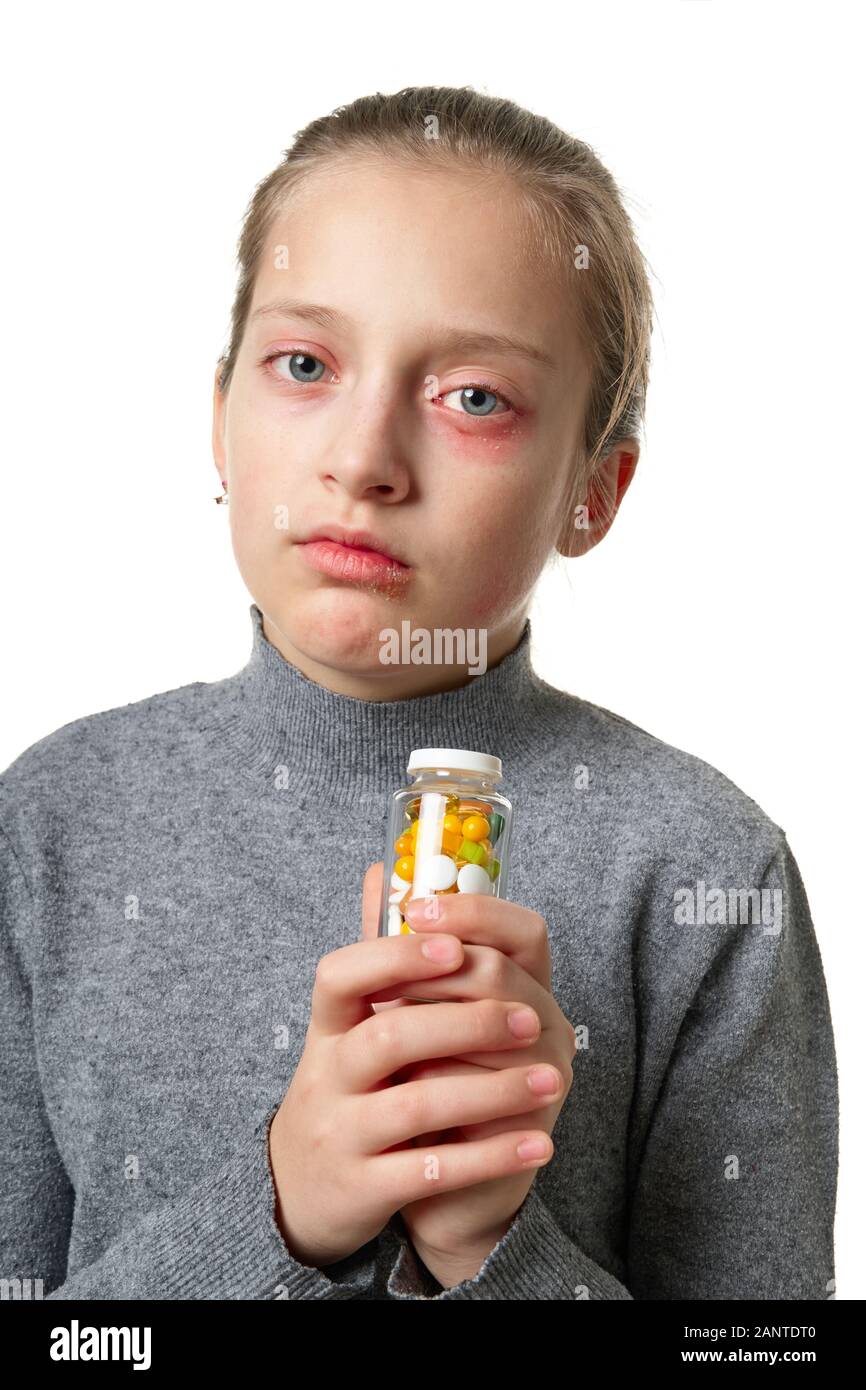 Allergic reaction, skin rash, close view portrait of a girl's face. Redness and inflammation of