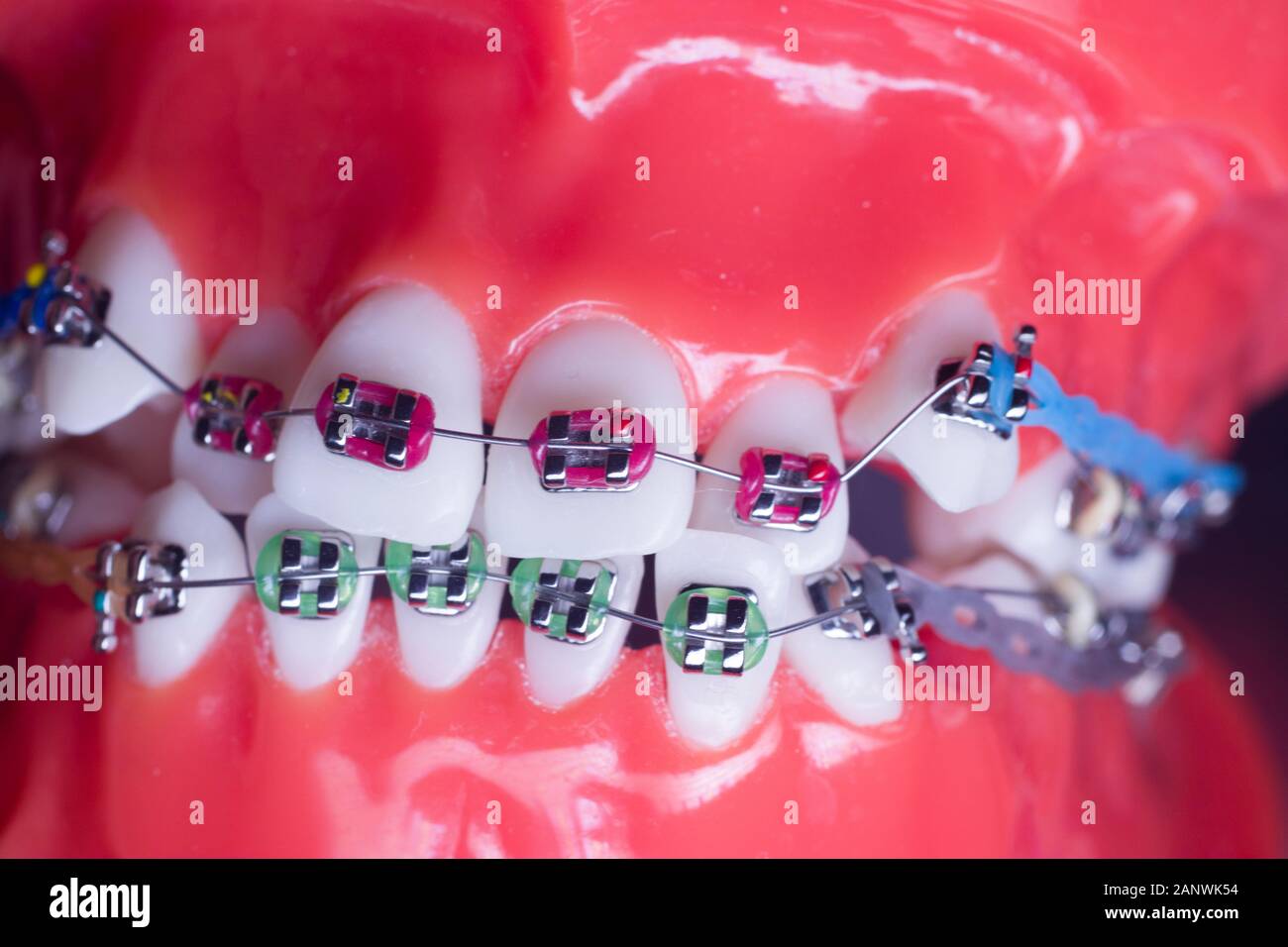 Modern metal retainers and plastic algners wire dental brackets teeth