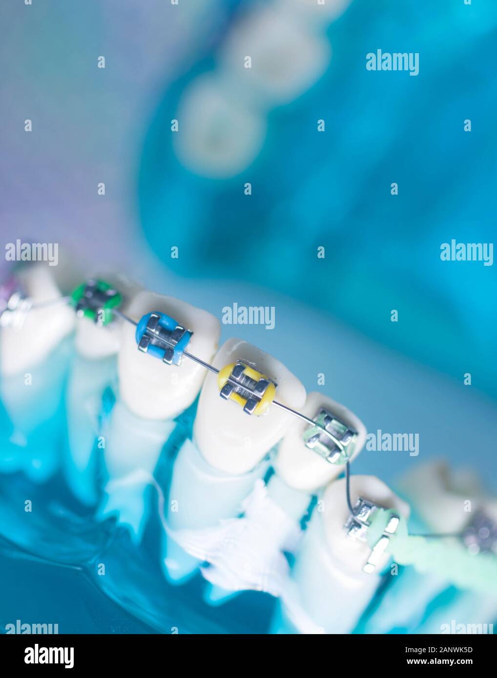 Modern metal retainers and plastic algners wire dental brackets teeth straighteners Stock Photo