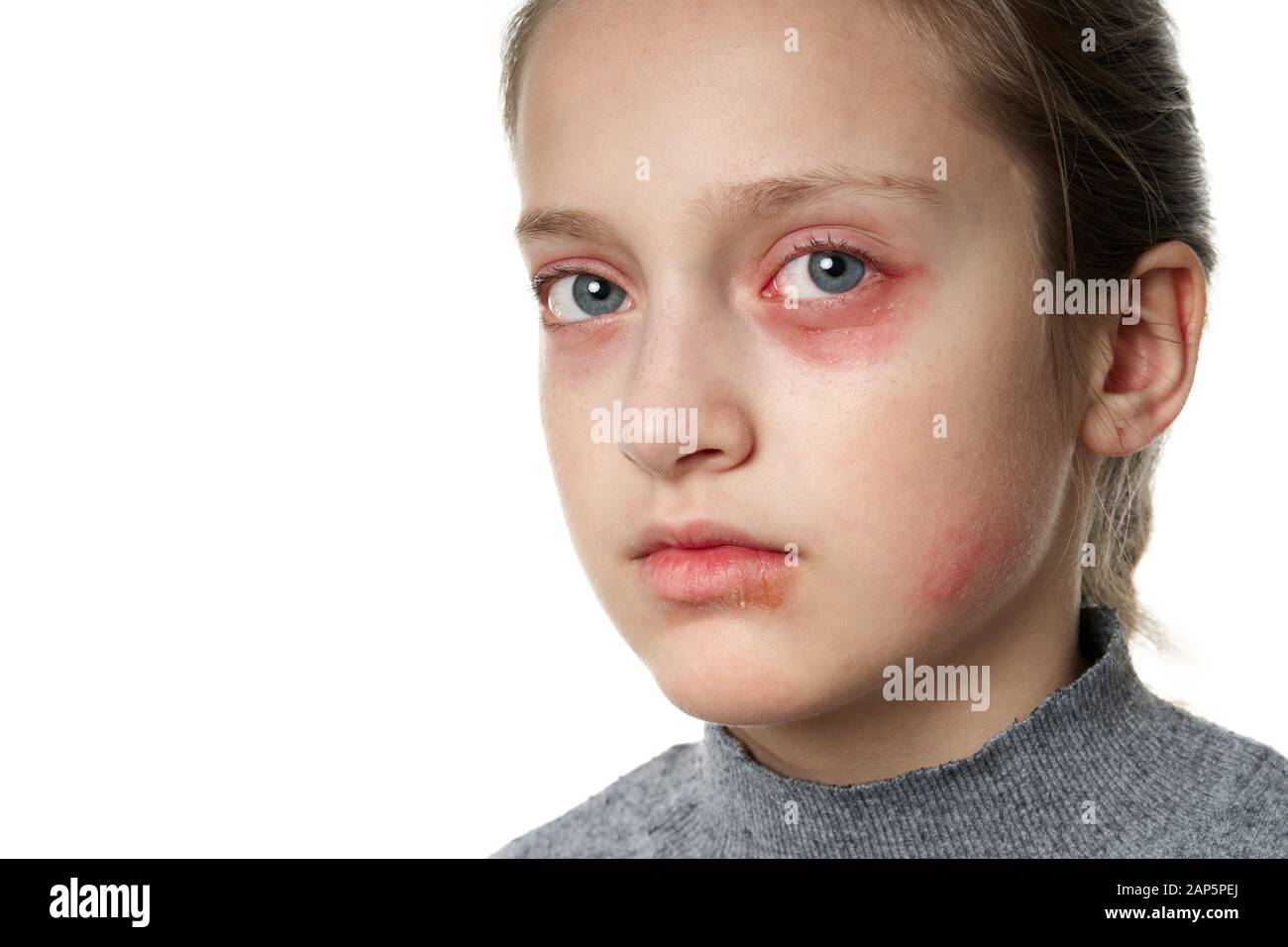 Allergic reaction, skin rash, close view portrait of a girl's face. Redness and inflammation of