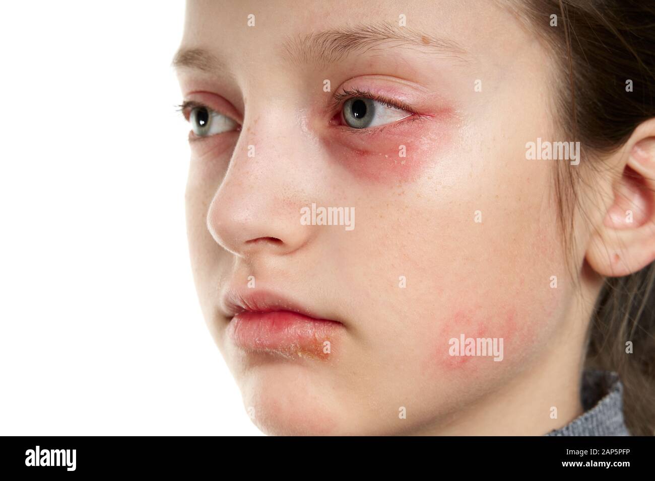 Allergic reaction, skin rash, close view portrait of a girl's face. Redness and inflammation of