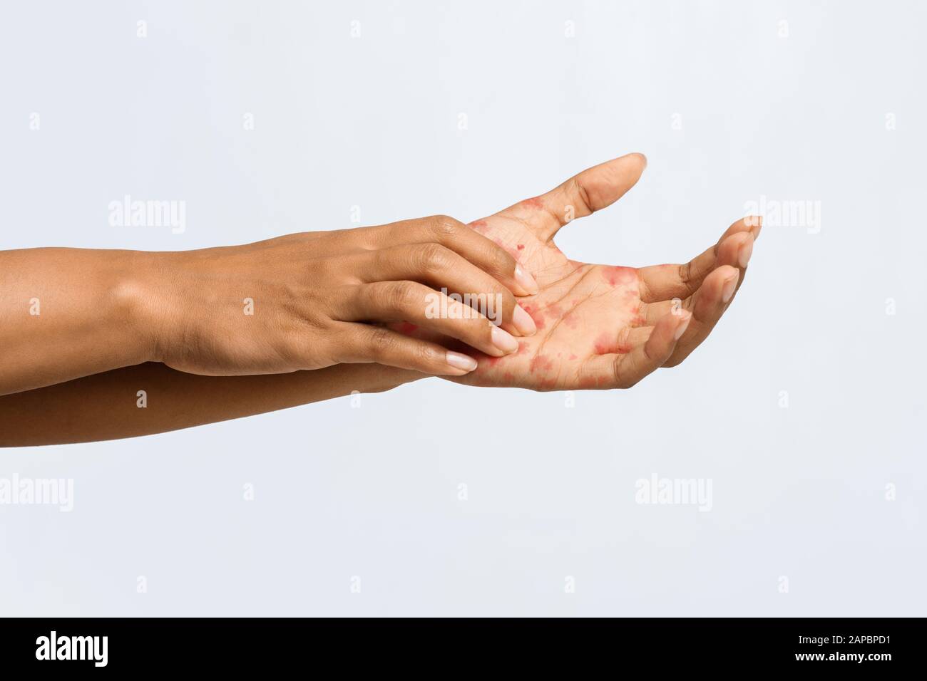 Afro woman having eczema on her palm Stock Photo