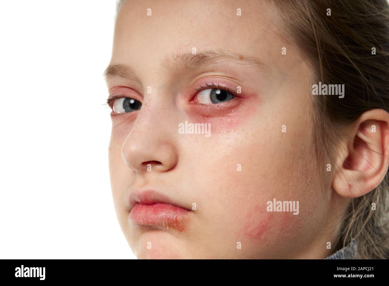 Allergic reaction, skin rash, close view portrait of a girl's face