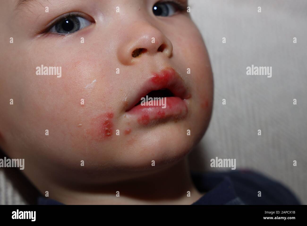 Hand Foot Mouth virus disease on child Stock Photo
