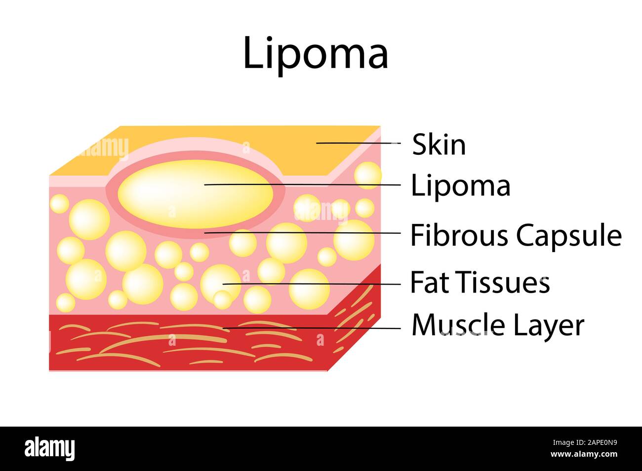 Lipoma are adipose tumors located in the subcutaneous tissues. Stock Vector