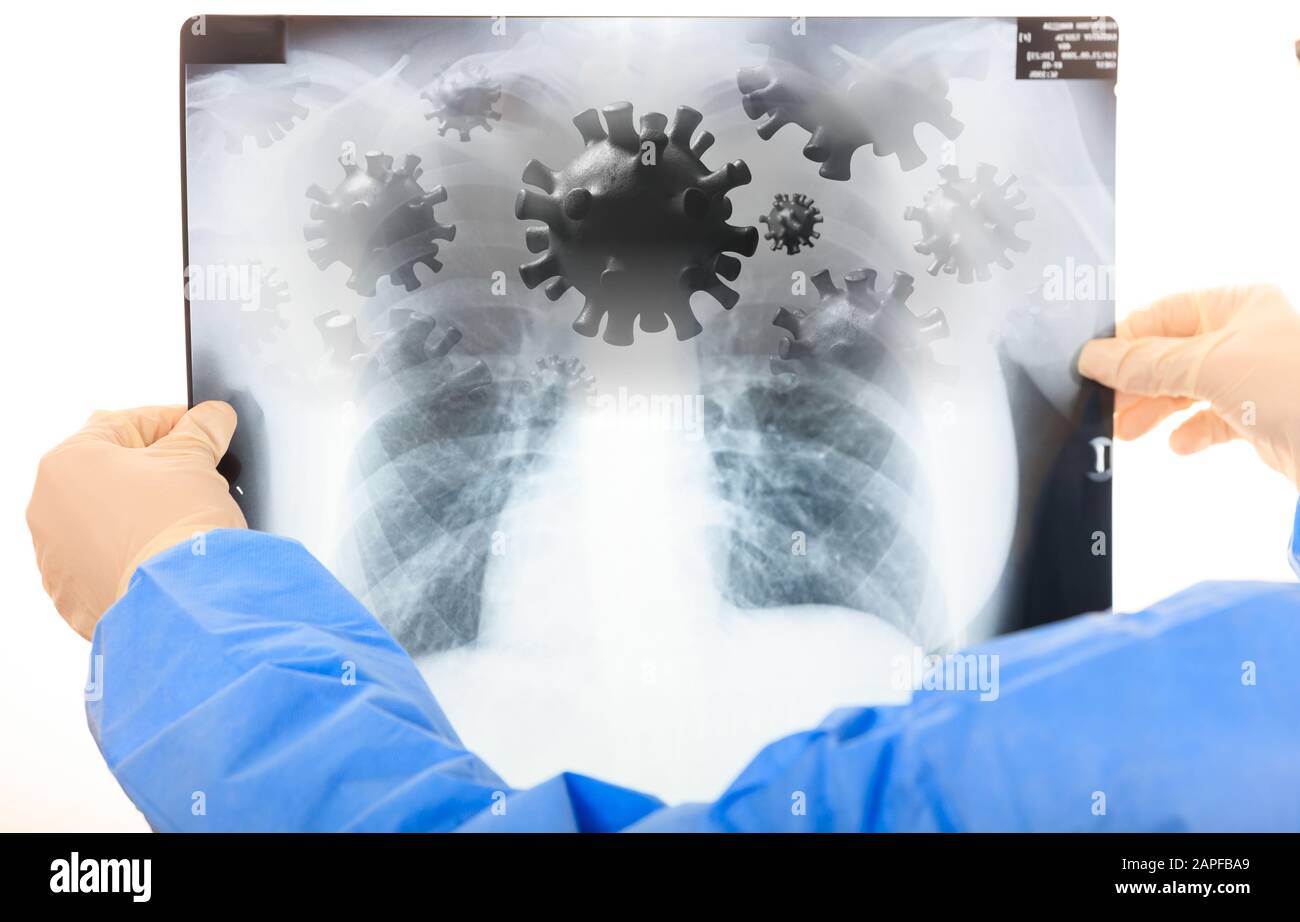 Coronavirus infection, flu respiratory syndrom, doctor holding a lungs Xray, virus infection concept. 3d illustration Stock Photo