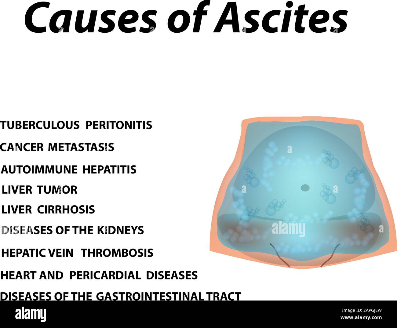 Ascites In Abdomen
