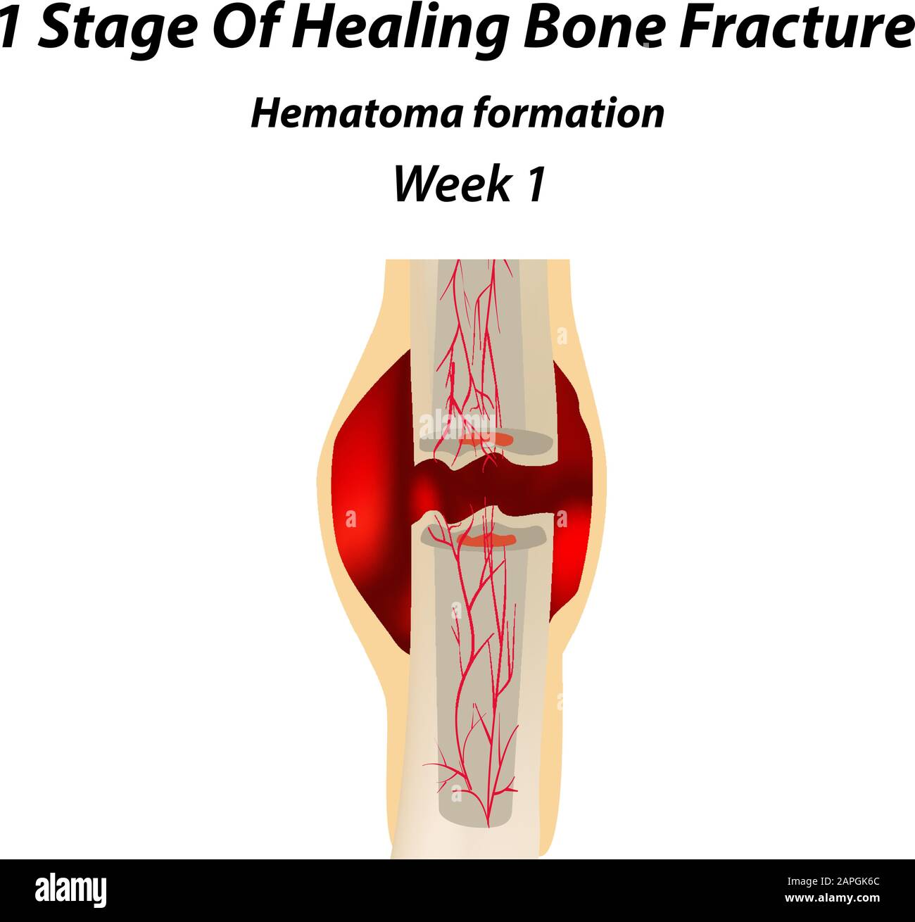 1 Stage Of Healing Bone Fracture. Formation of callus. The bone