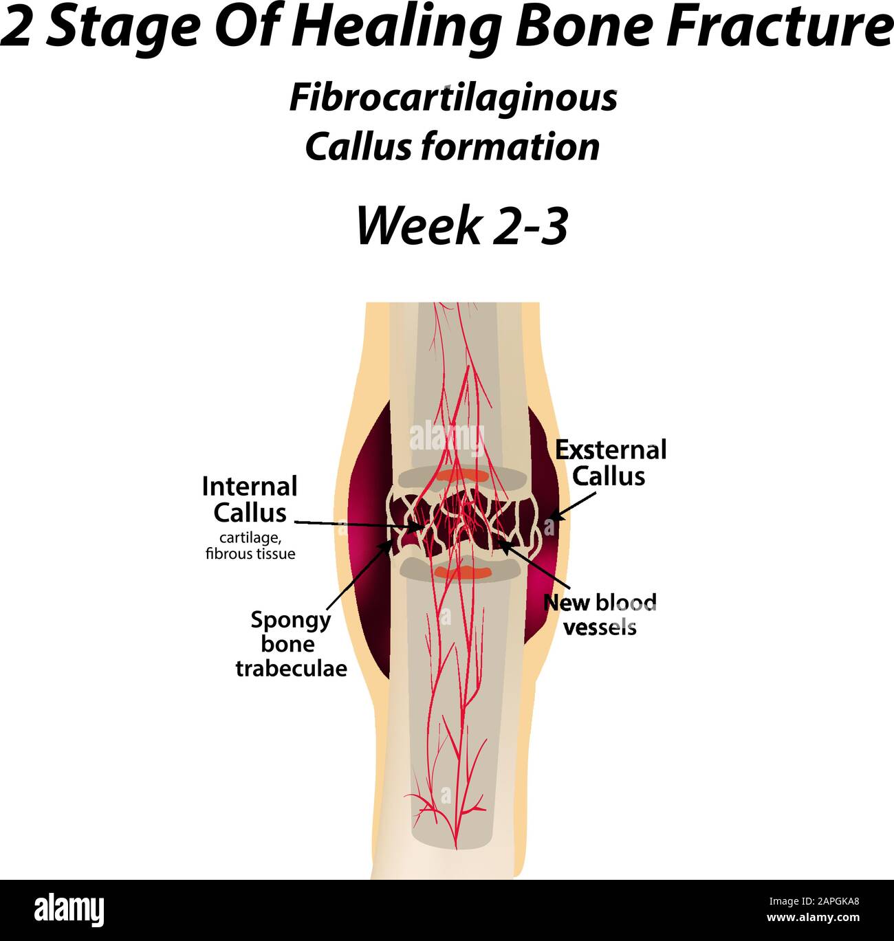 2 Stage Of Healing Bone Fracture. Formation of callus. The bone