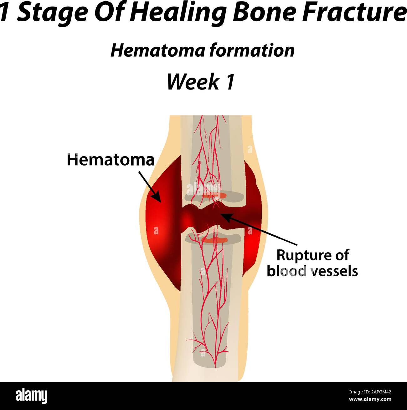 Initial Callus Formation 1 Stage Of Healing Bone Fracture. Formation of callus. The bone ...