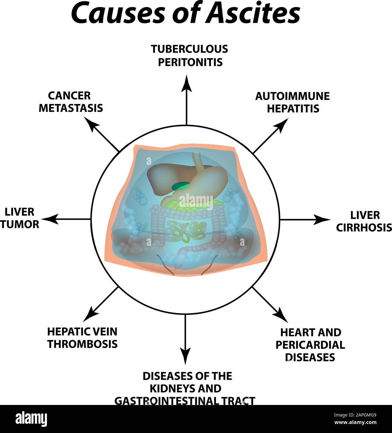 Ascites Free fluid in the abdominal cavity. Infographics. Vector