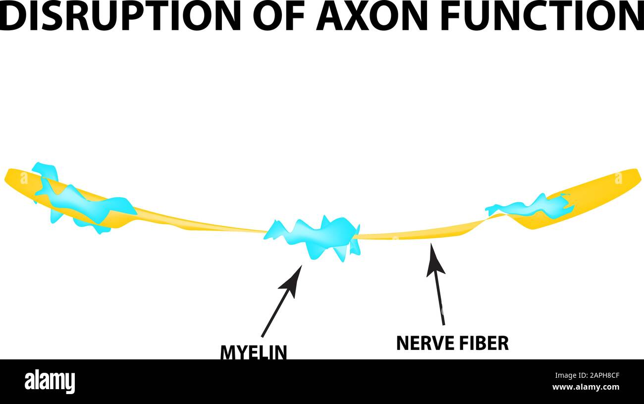 The Destruction Of The Myelin Sheath On The Axon Damaged Myelin The Destruction Of The Myelin Sheath On The Axon Damaged Myelin