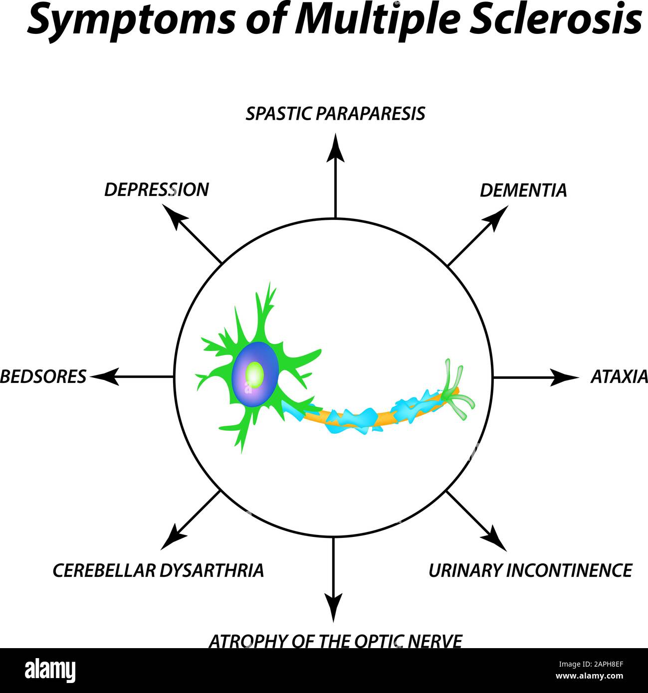 Symptoms of multiple sclerosis. The destruction of the myelin sheath on the axon. Damaged myelin