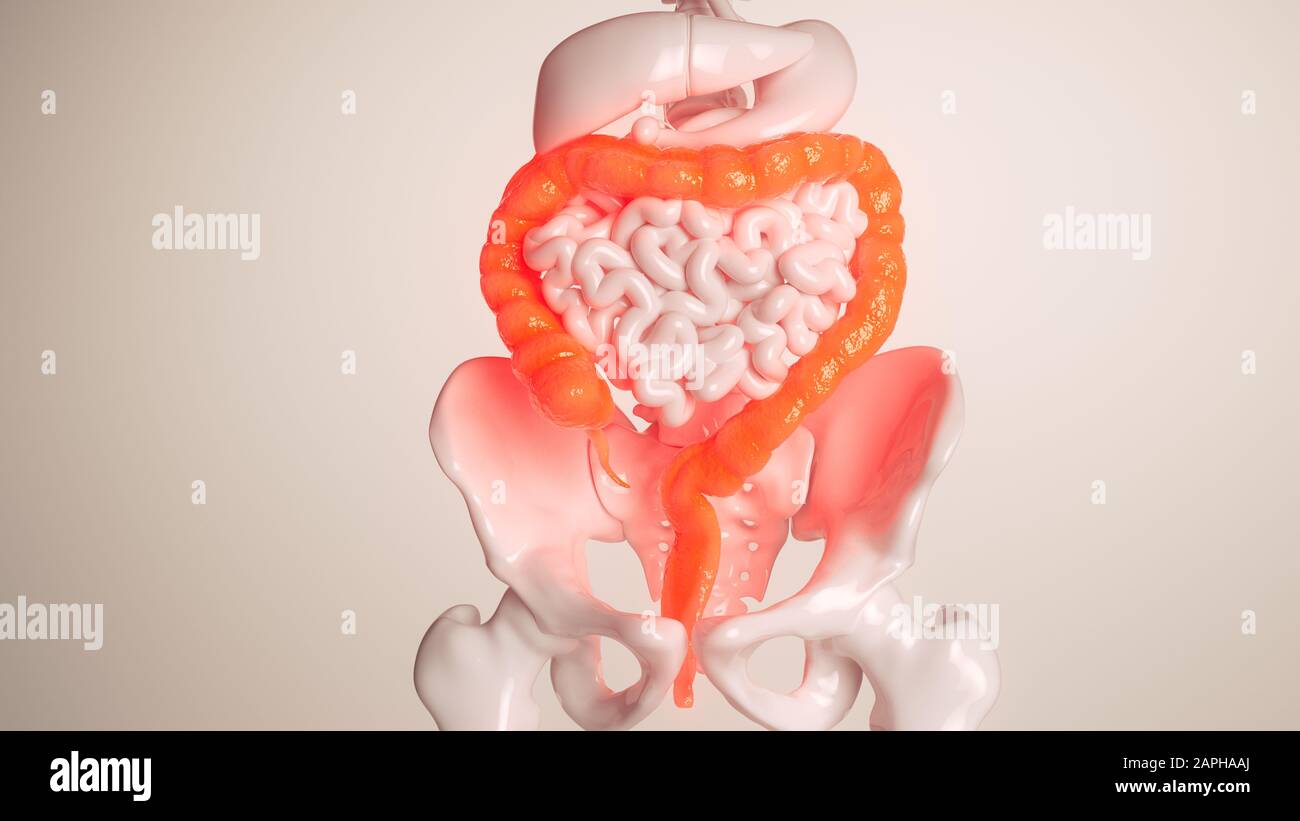 Inflammation of the large intestine - 3D rendering Stock Photo - Alamy